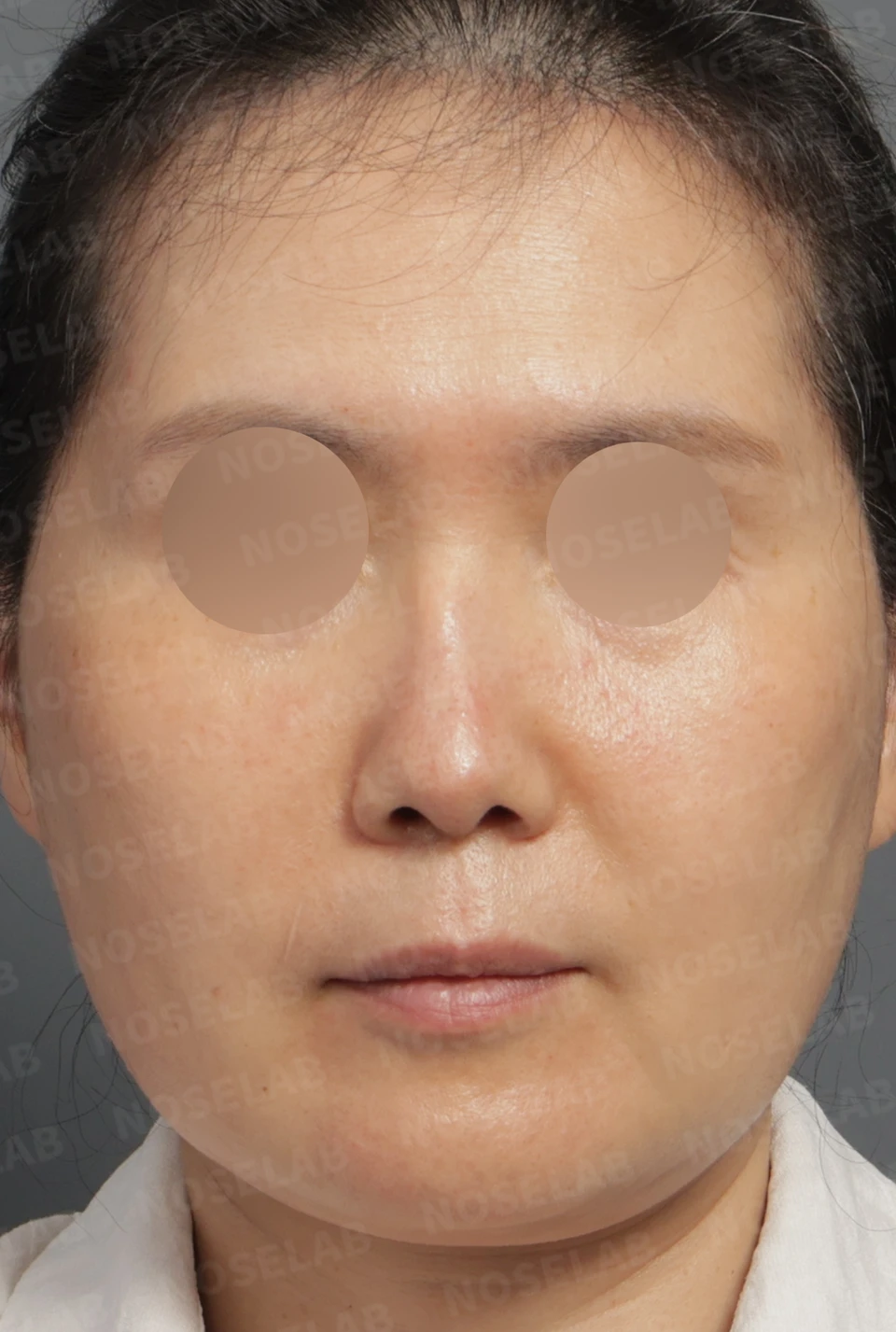 Preoperative consultation: frontal view.