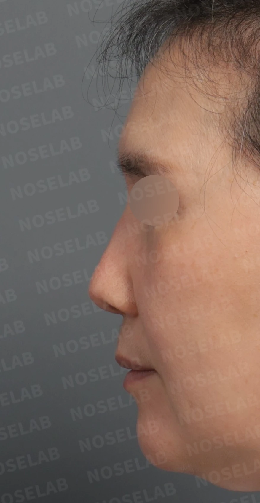Preoperative consultation: left profile.