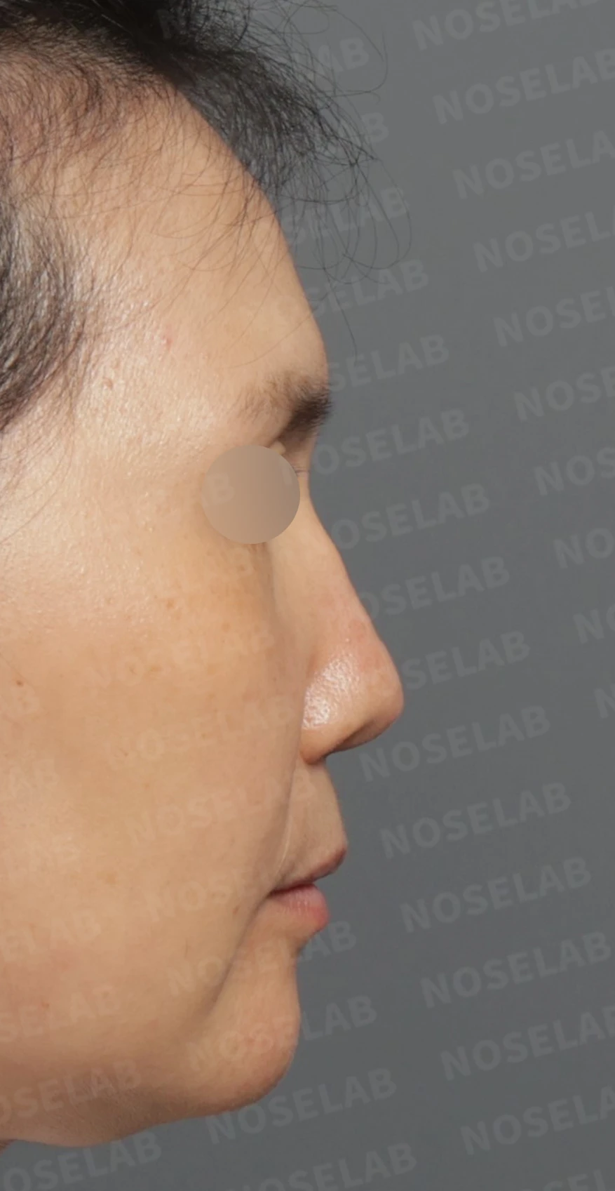Preoperative consultation: right profile.
