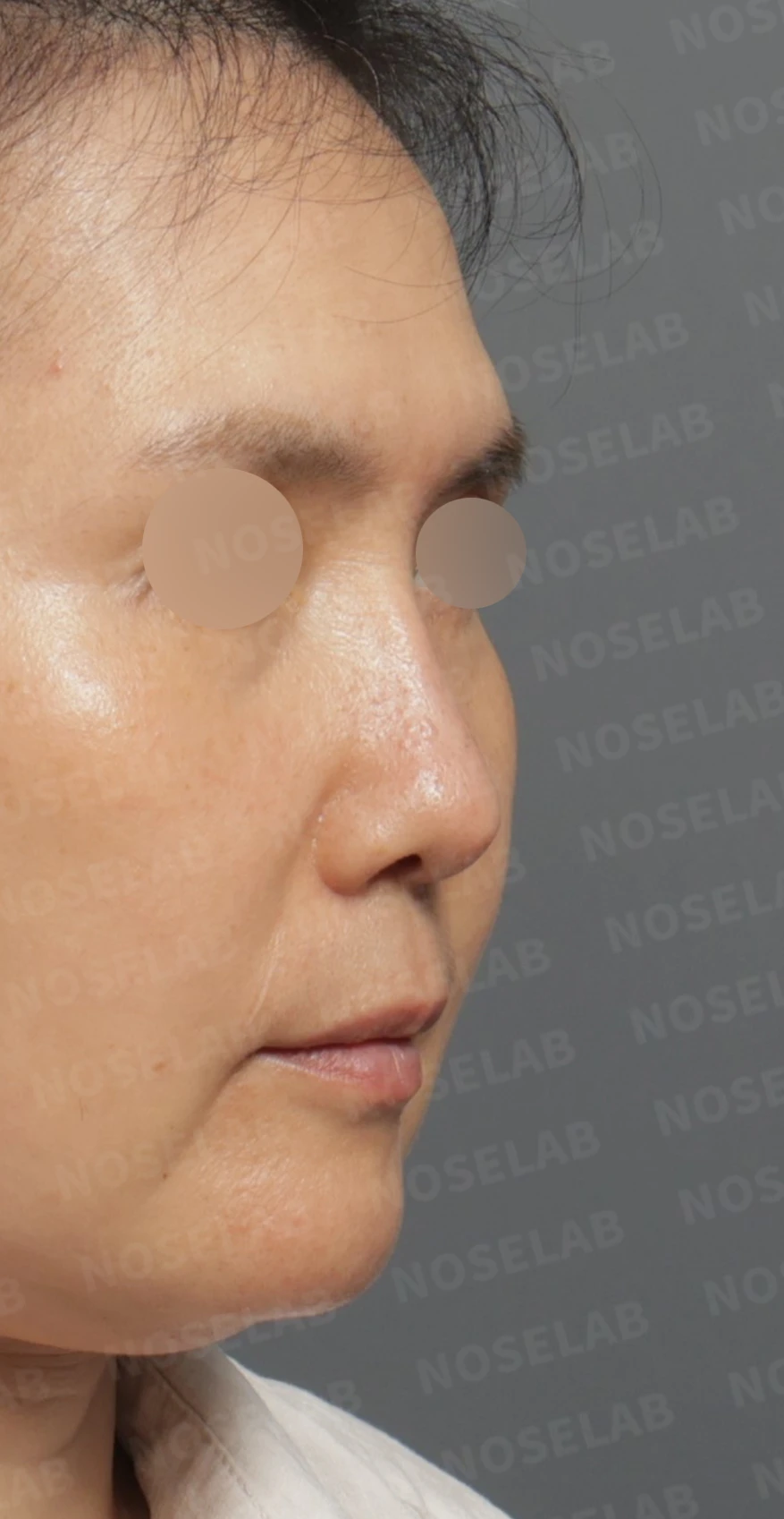 Preoperative consultation: right oblique view.