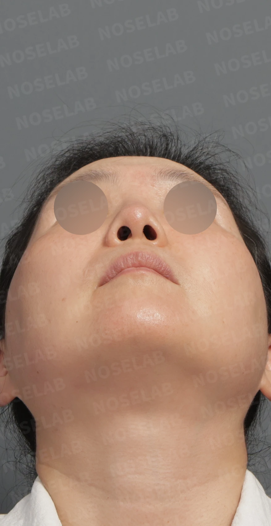 Preoperative consultation: nostril view.