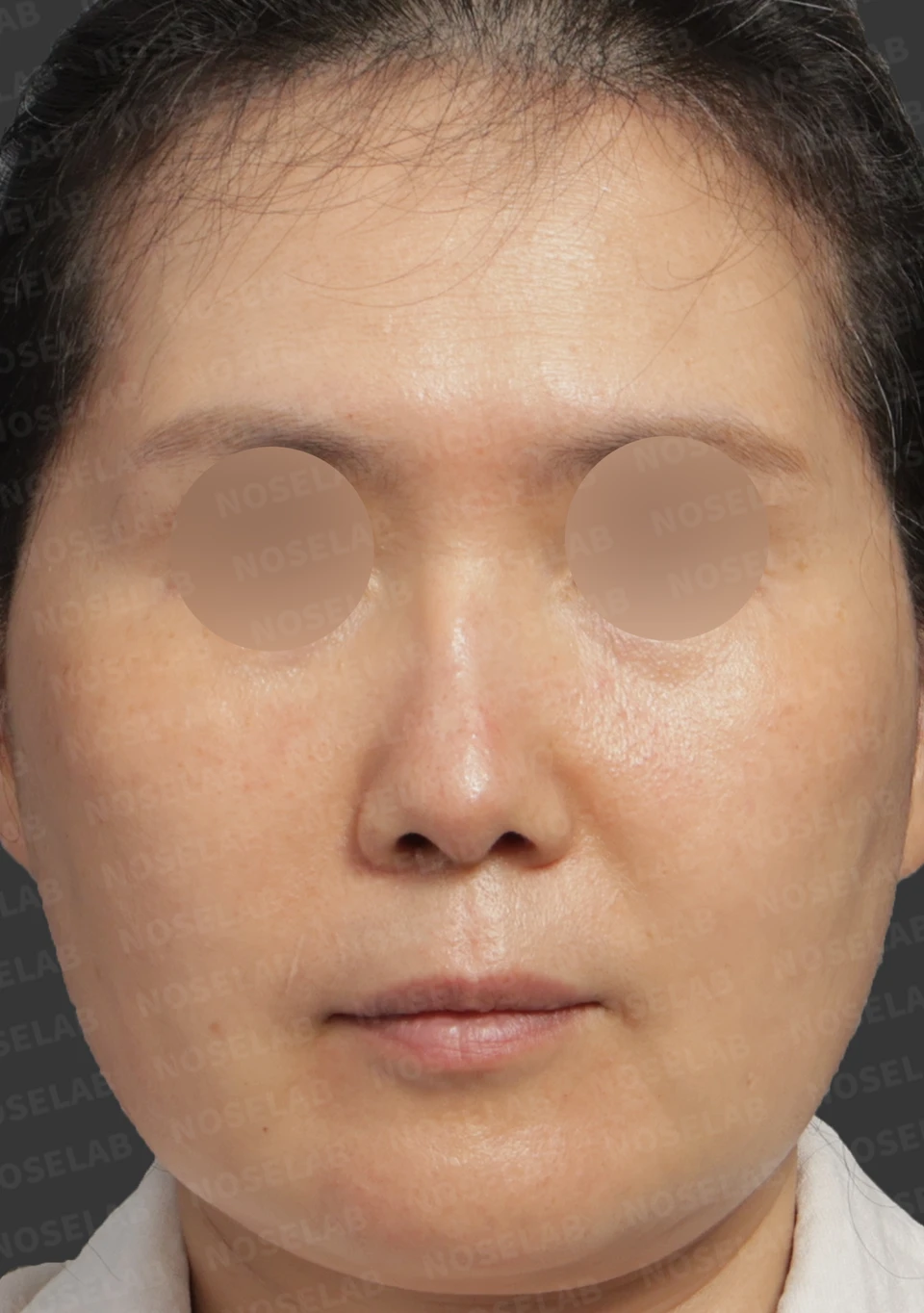 Before surgery: frontal view.