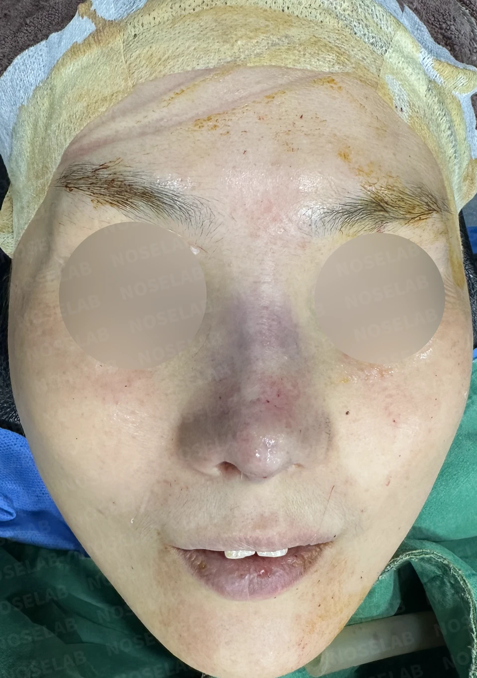 Immediately after surgery: frontal view.