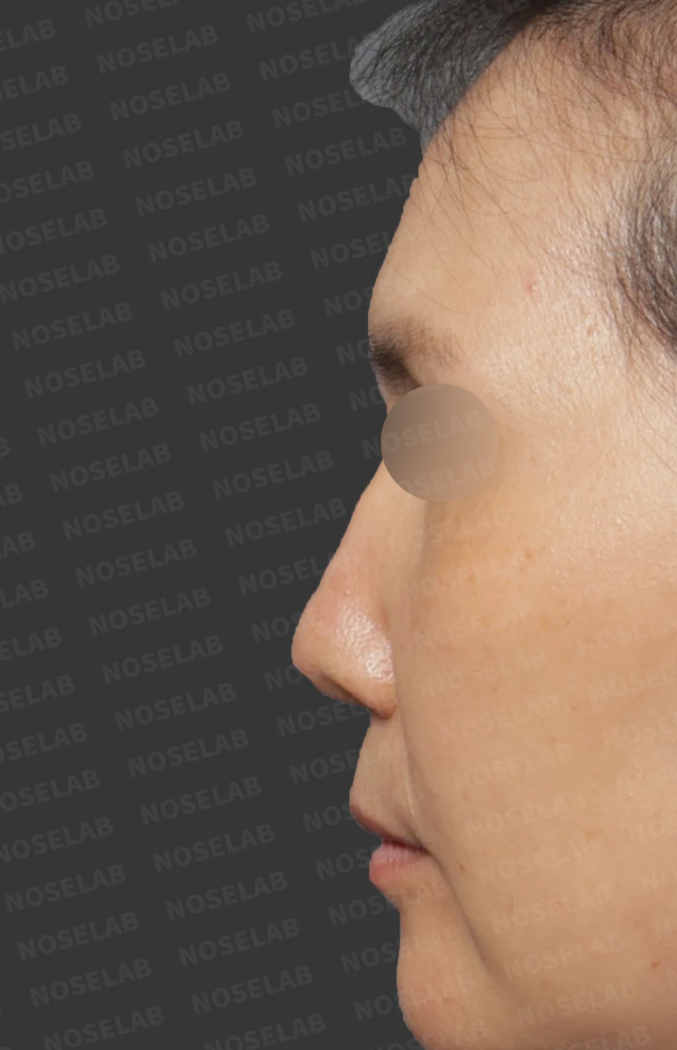 Before surgery: left profile.