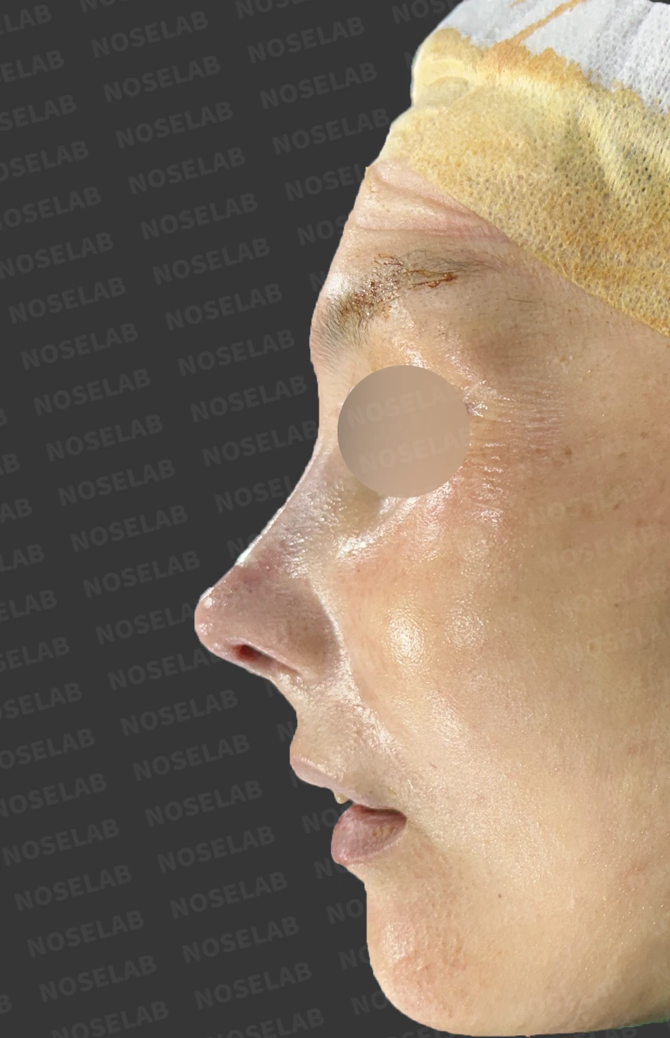 Immediately after surgery: left profile.