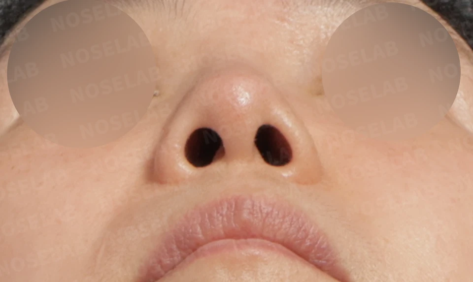 Before surgery: nostril view.