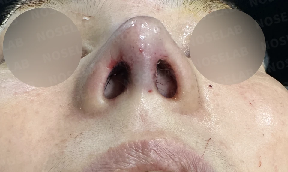 Immediately after surgery: nostril view.