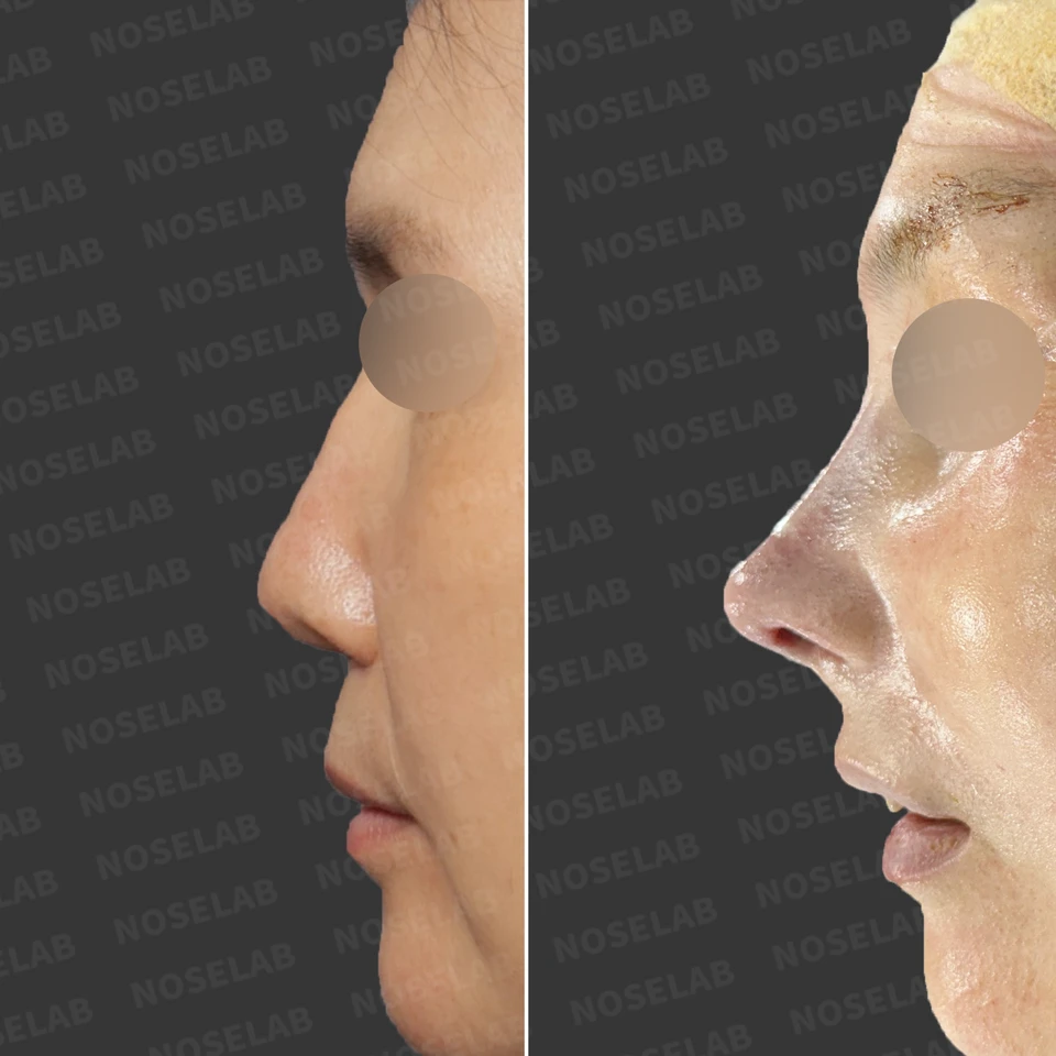 Profile comparison: before surgery (left), immediately after surgery (right).