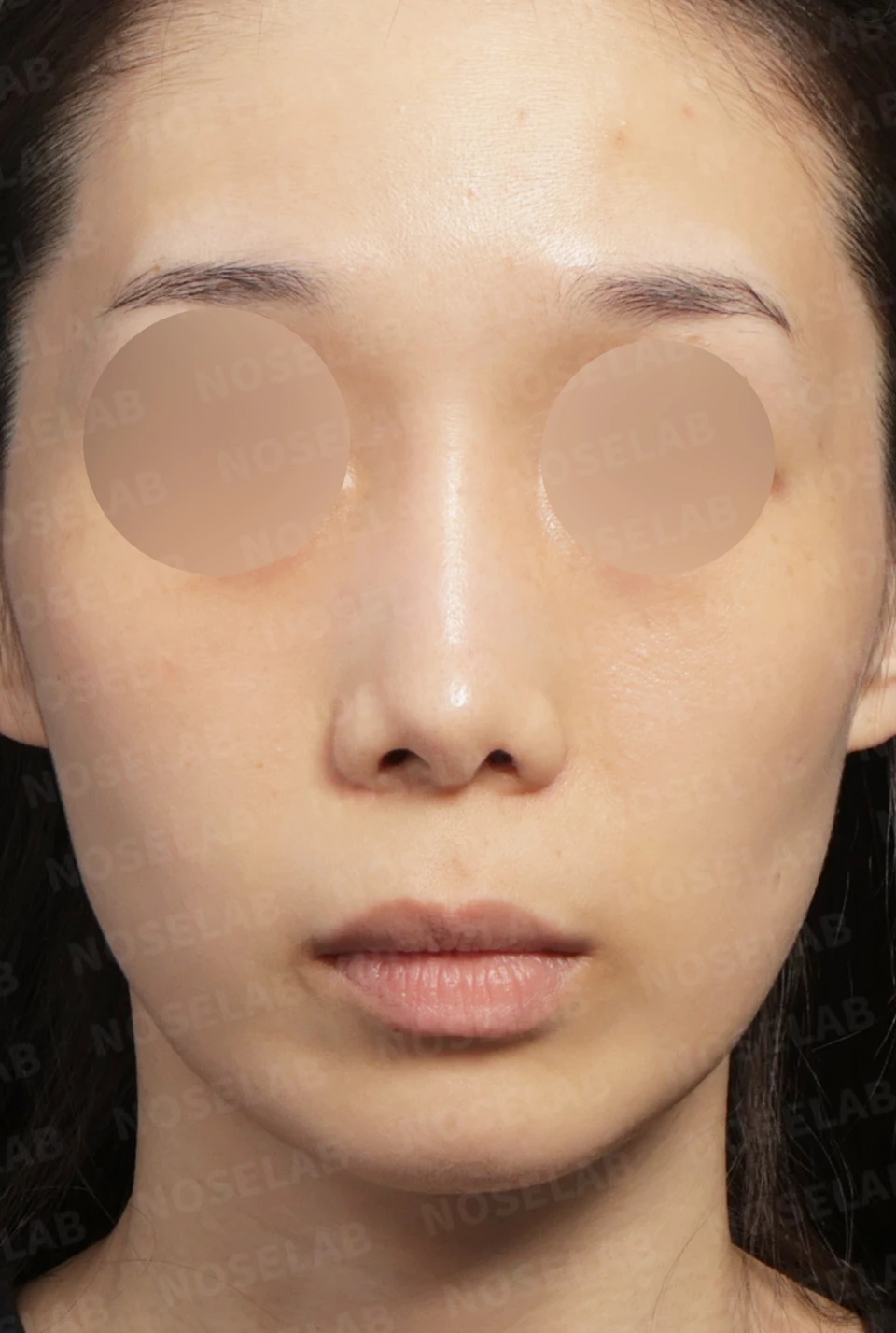 Preoperative consultation: frontal view.