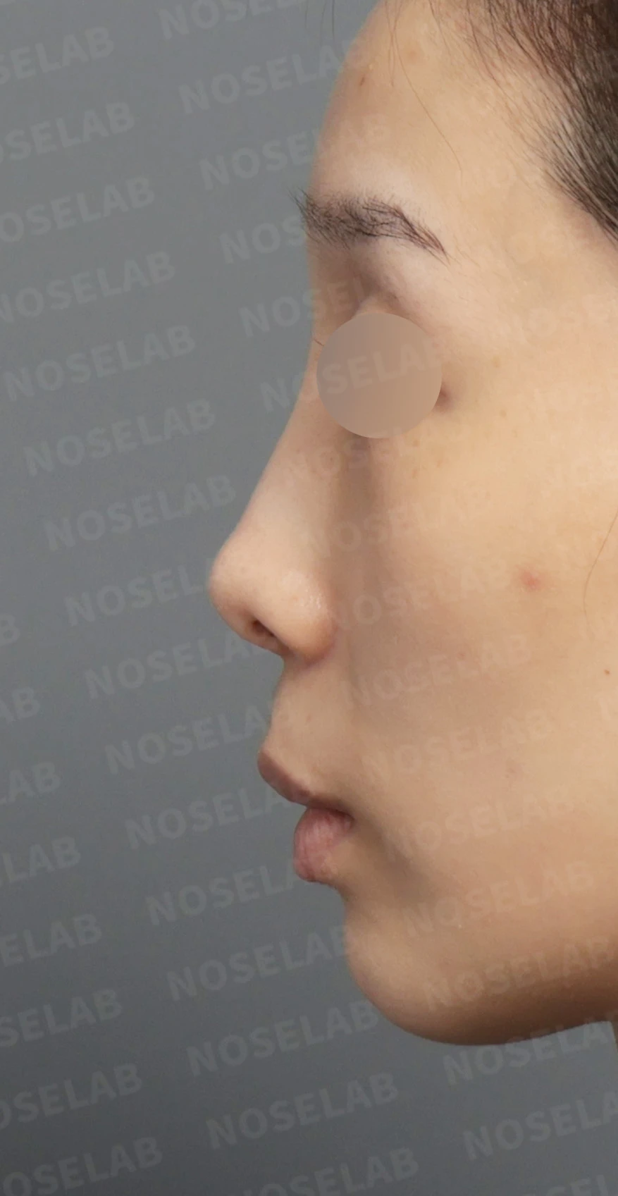 Preoperative consultation: left profile.