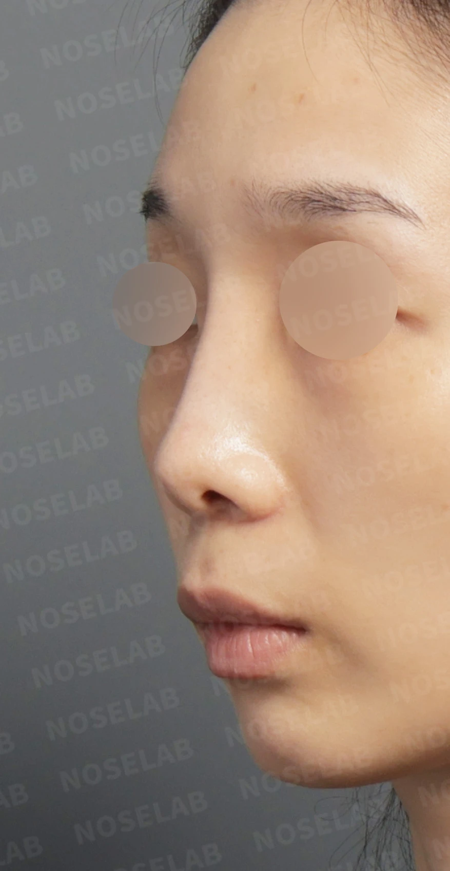 Preoperative consultation: left oblique view.