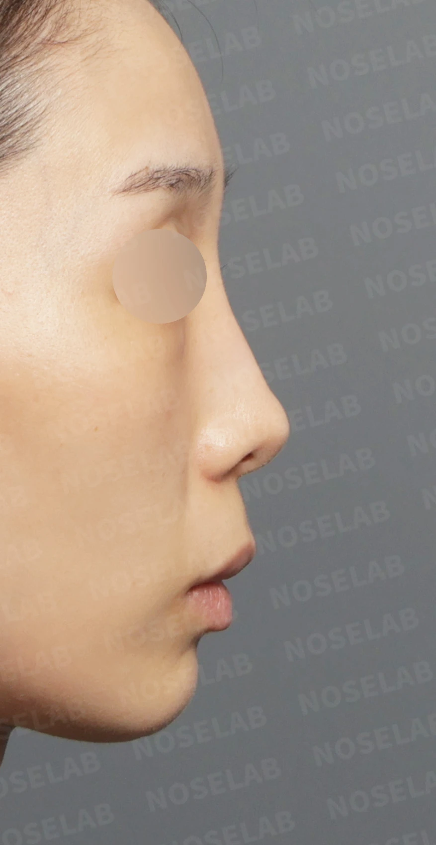 Preoperative consultation: right profile.