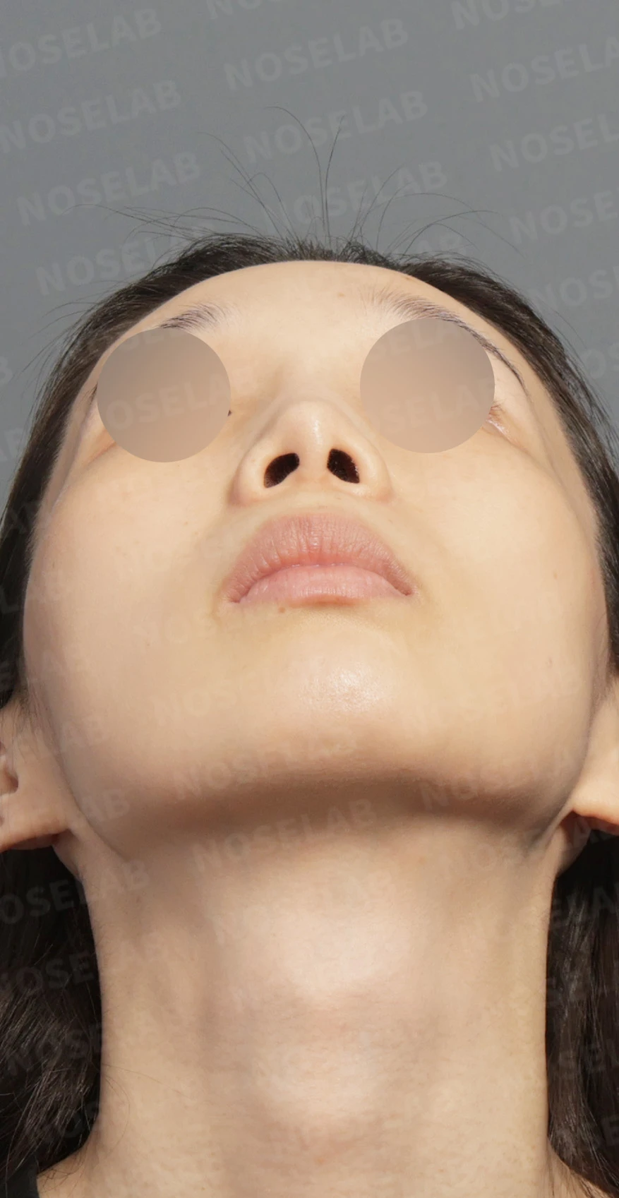 Preoperative consultation: nostril view.