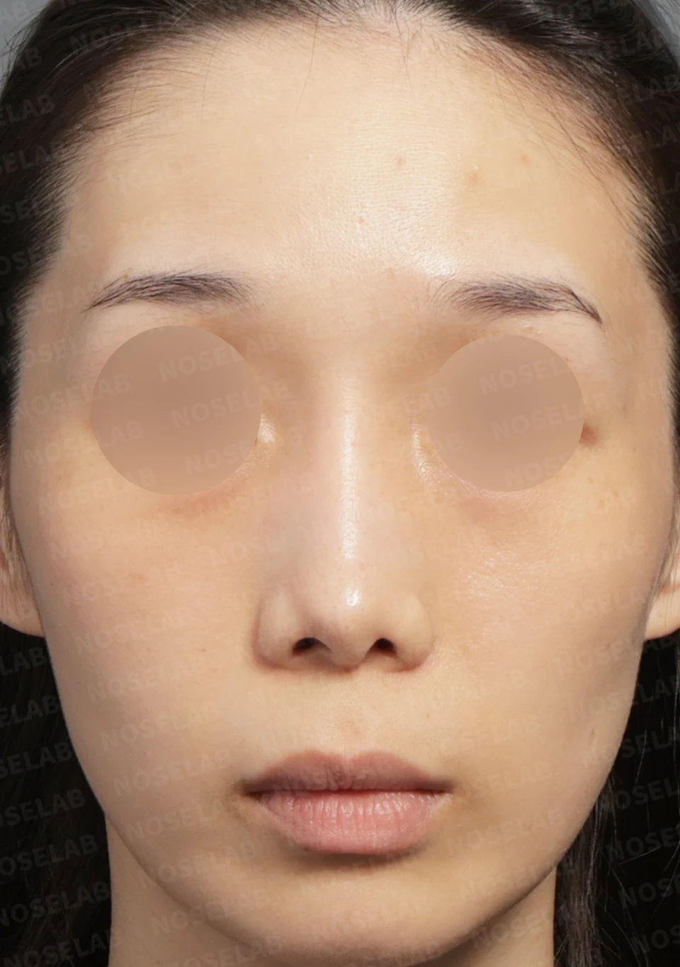 Before surgery: frontal view.