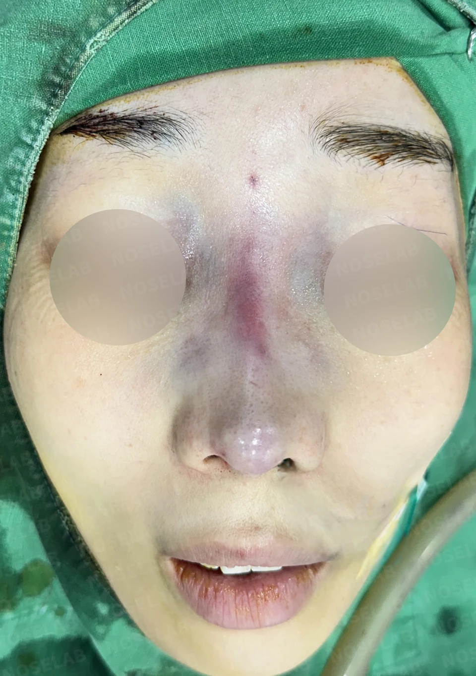 Immediately after surgery: frontal view.