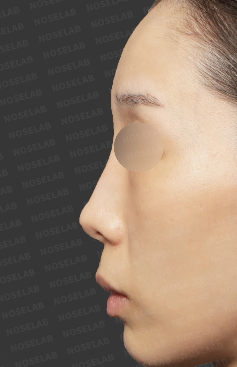 Before surgery: left profile.
