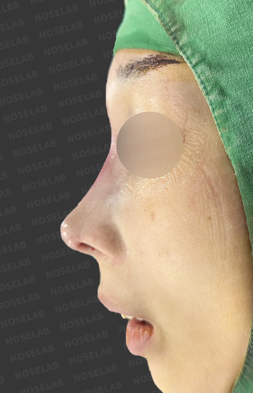 Immediately after surgery: left profile.