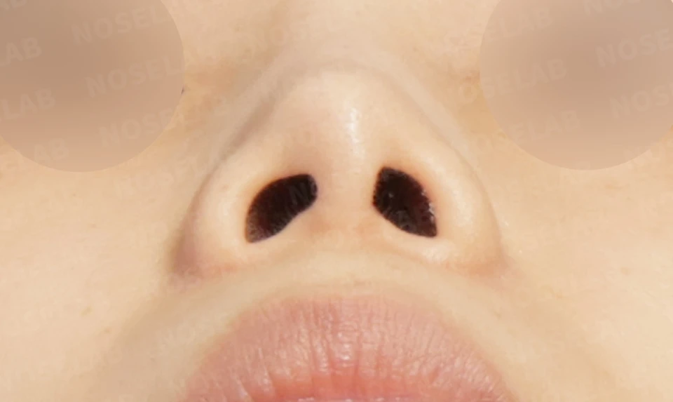 Before surgery: nostril view.