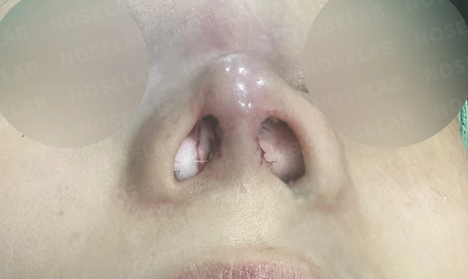 Immediately after surgery: nostril view.