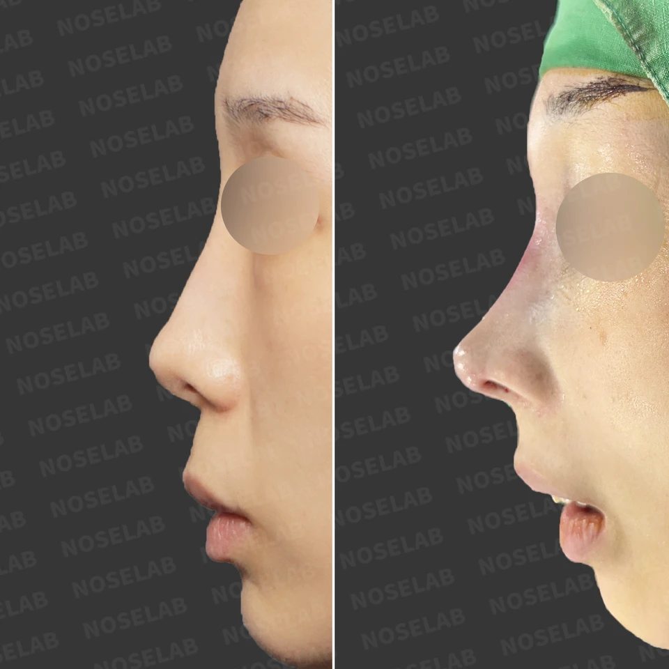 Profile comparison: before surgery (left), immediately after surgery (right).